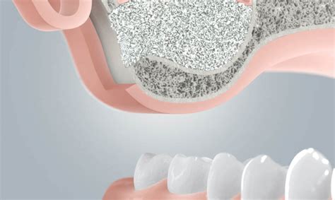  Junktionierung: Bioresorbierbare Implantate für einen stabilen Knochenaufbau!